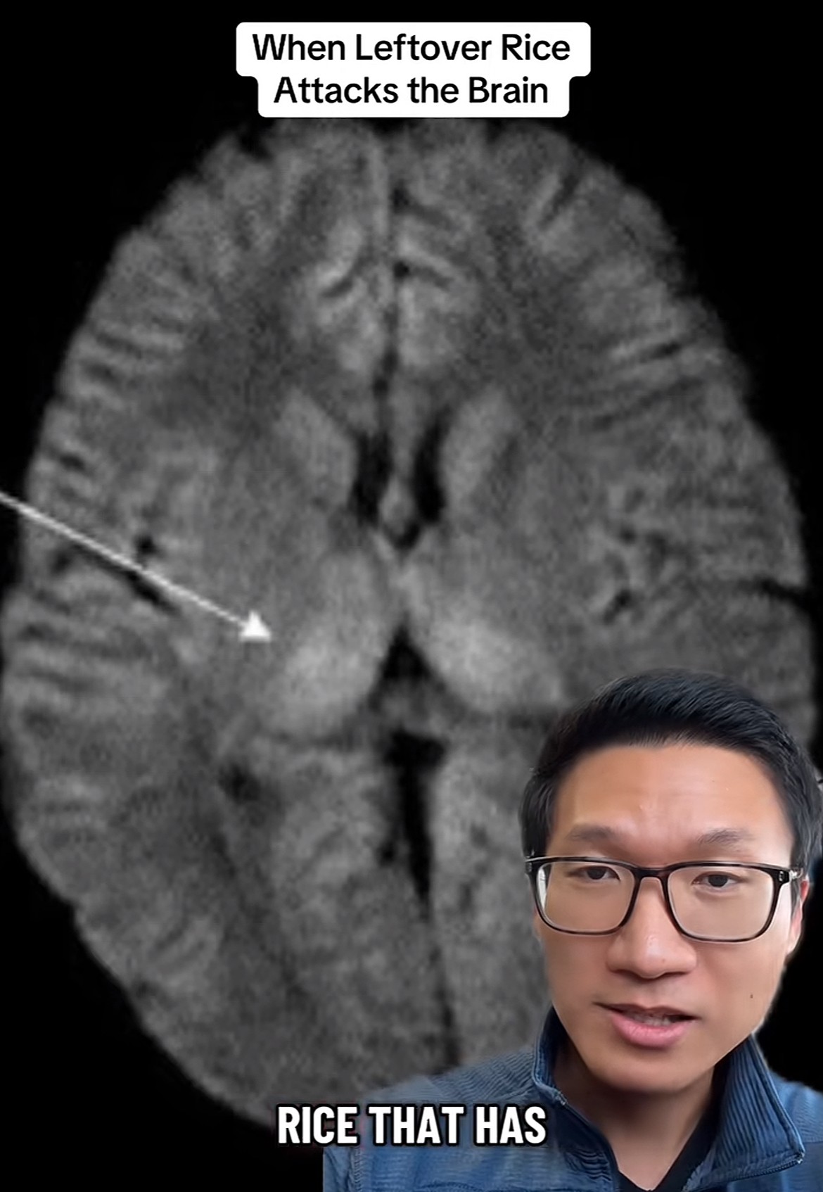 Neurológ varuje pred konzumáciou zvyškov ryže, ktoré môžu ohroziť mozog, najmä u detí.