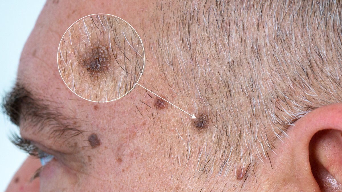 Melanom je obično tamniji i veći od staračkih pega