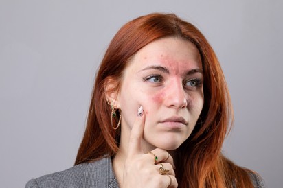 Felnőttkorban is kialakulhat ekcéma: ezeket teheti ellene