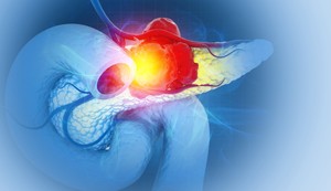 Simptomi raka pankreasa u ranoj fazi često izostaju 