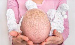Łojotokowe zapalenie skóry u niemowląt - objawy i leczenie