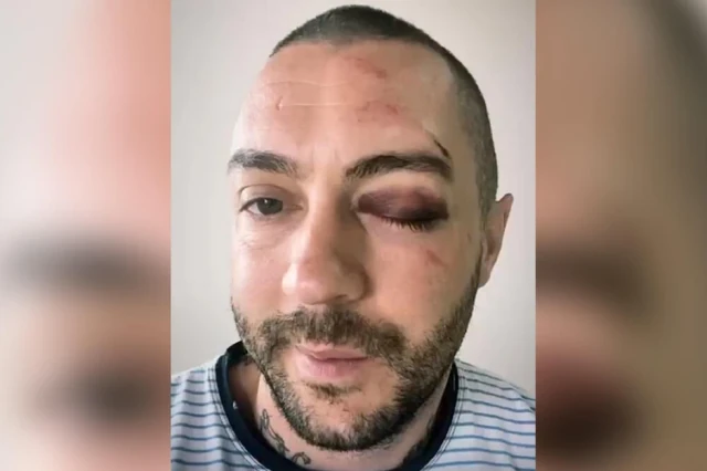 "PUKLA MI JE ČEONA KOST, SVE MI JE SMRSKANO, moram na operaciju!" Jodžir je pre tri godine sve zabrinuo snimkom