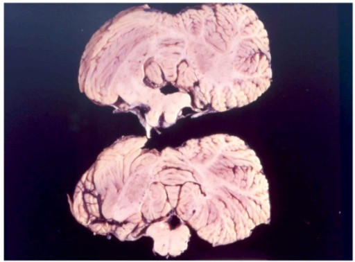 Mózg osoby dotkniętej chorobą kuru