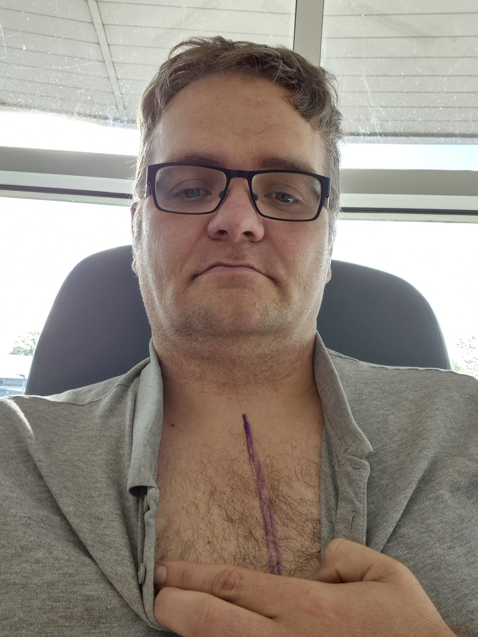 Lekári mu diagnostikovali rakovinu prsníka.