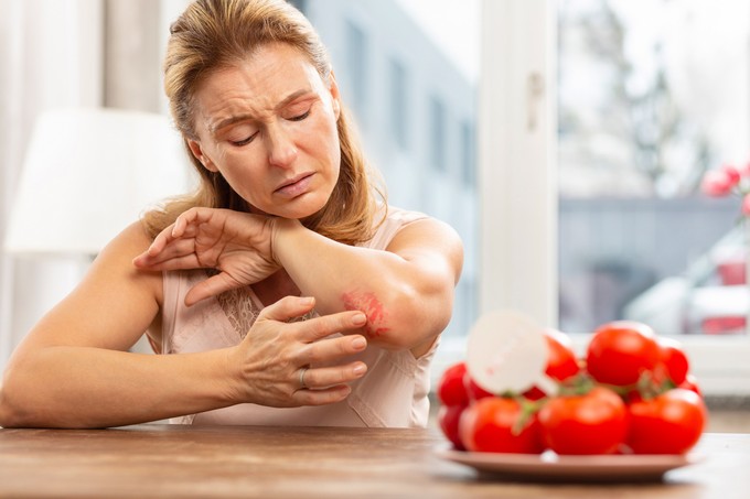 Ételallergia és allergiás kiütések: ezt üzeni a bőr az immunrendszerünkről