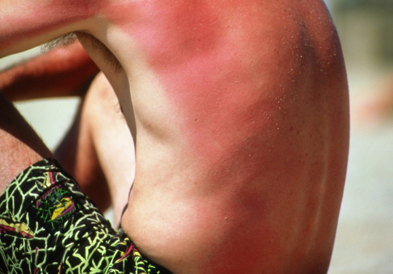 Sunburn