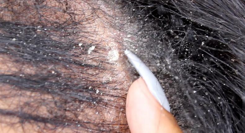 Causes of dandruff on your hair (YouTube)