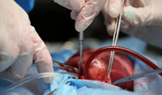 Prof. Zembala: "przygotowujemy się do jednoczasowego przeszczepu serca i płuc".