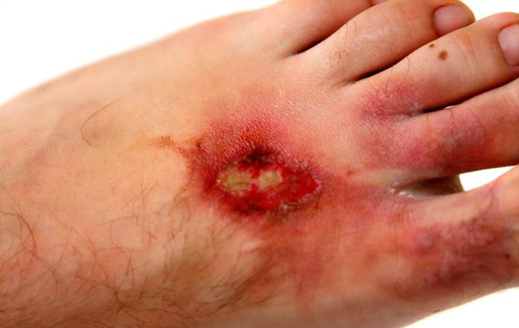 Niegojące się rany stóp