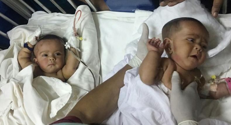 Tofa and Tahura, ten-month-old twins who were born conjoined at the spine and rectum, were separated by a team of two dozen doctors Tuesday in Dhaka