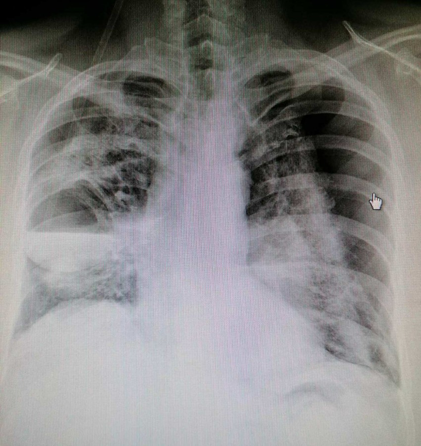 Snimak pluća nakon obostrane drenaže