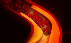 Zaskakujące, co ci podnosi cholesterol! Nie zawsze chodzi o dietę