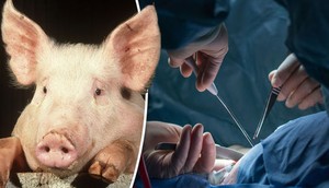 Kidney transplant done with pig's kidney [dailyexpress]