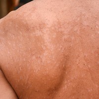 tjemenice kod bebe Cradle cap oil  Prirodna.com