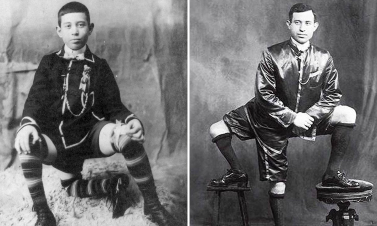 W dzieciństwie nazywali go potworem. Trzecia noga przyniosła mu sławę