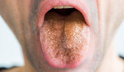 "Czarny włochaty język" - choroba, którą może wywołać zażywanie dużych ilości antybiotyków