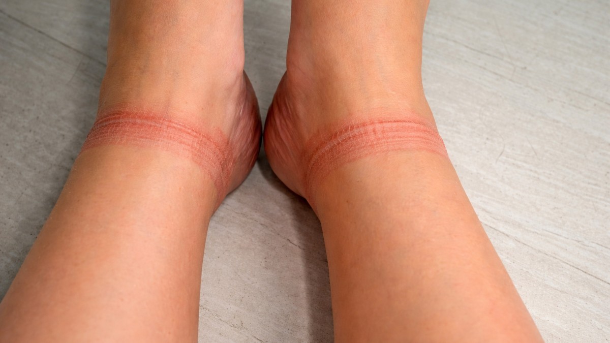Tragovi od čarapa na nogama – kad su udubljenja normalna, a kada ukazuju na bolest?