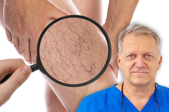 Da li posle operacije vena sme da se ide na more: Dr Jocić otkriva prve znake bolesnih vena i zašto ih leto razotkrije