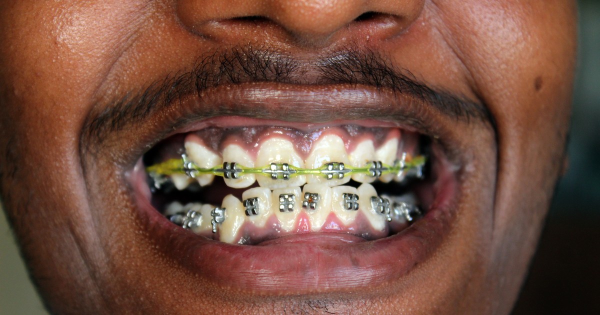 5 things you should know before you get braces Pulselive Kenya