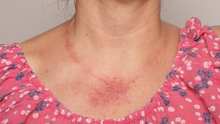 bőrpír erythema tünet bőrtünet