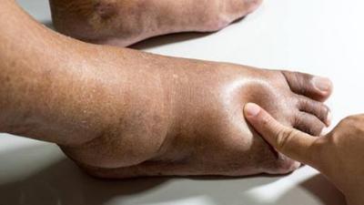 Leg swelling is also known as edema [Shutterstock]