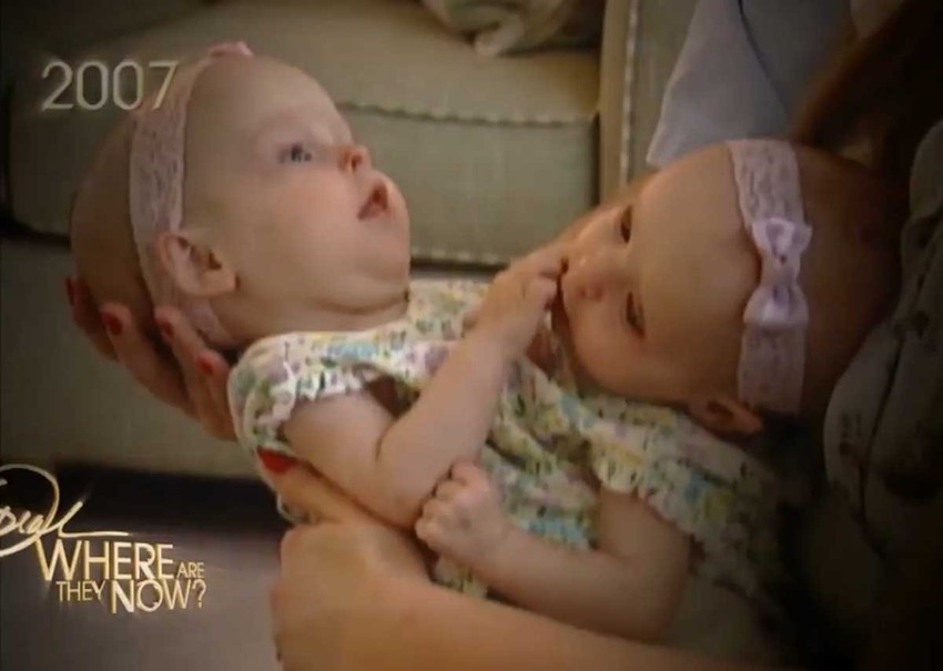 Uspele su da pobede visoku stopu smrtnosti kod sijamskih blizanaca