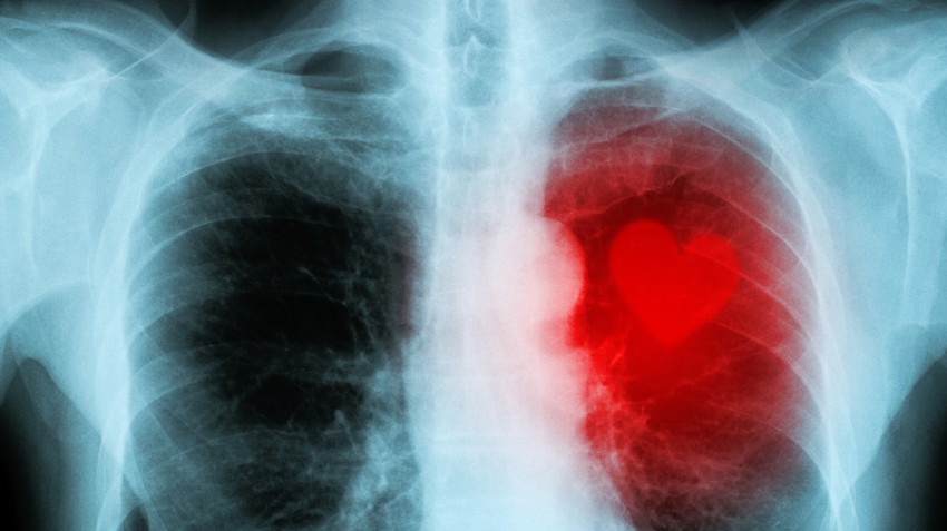 szívizomgyulladás, myocarditis, covid, oltás, mrns, vakcina, Pfizer, Moderna