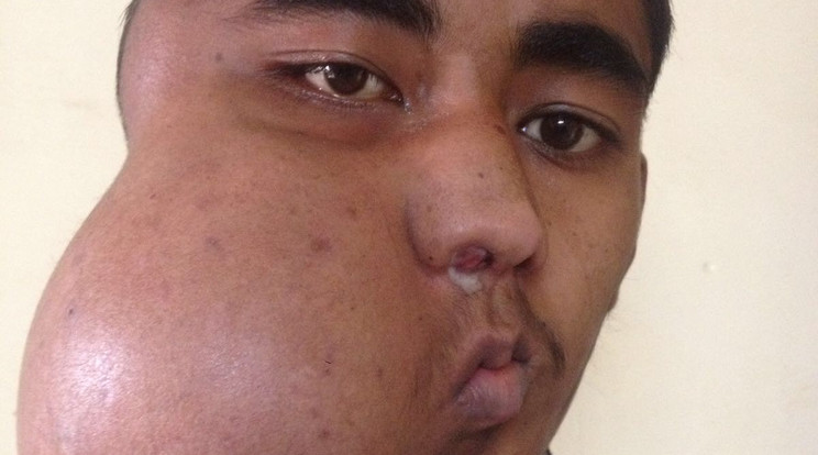 Háromnegyed kilós tumort távolítottak el egy indiai férfi orrából / Fotó: Northfoto