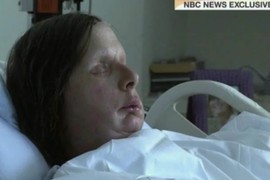 Žena kojoj je ŠIMPANZA IŠČUPALA NOS, KAPKE, USTA I RUKE otkriva kako izgleda 16 godina posle JEZIVOG NAPADA: Pomahnitala životinja je unakazila, lekari uradili TRANSPLANTACIJU LICA