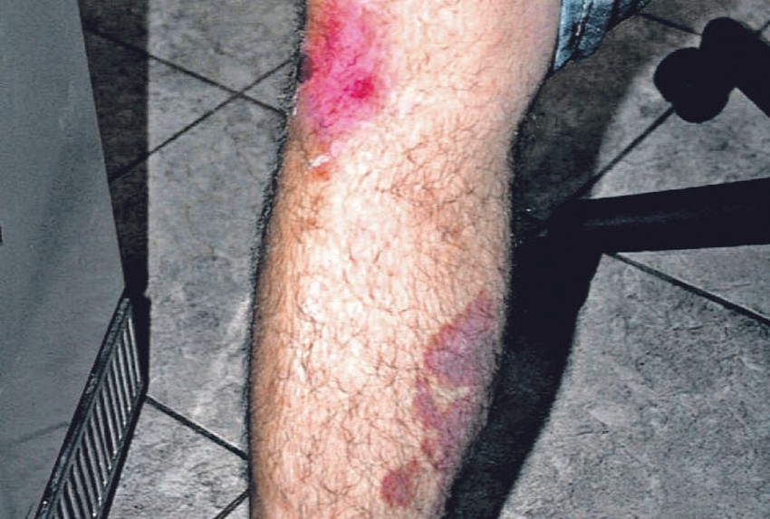 Povrede: Masnice na nozi I. M.