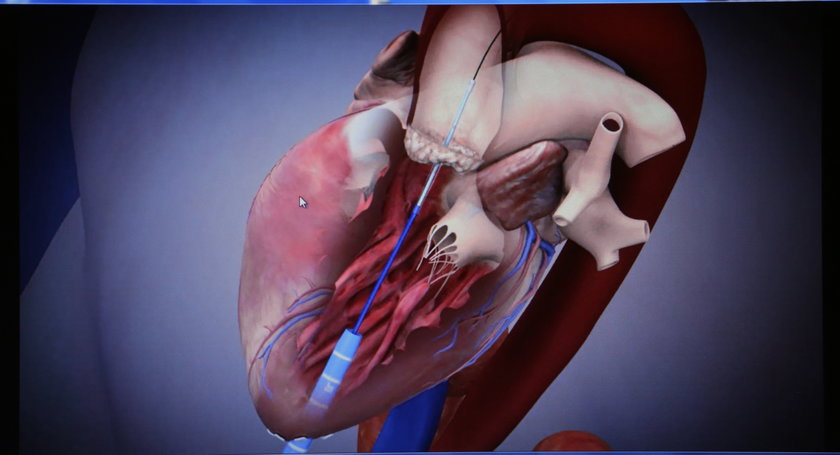 wszczepienie zastawki aorty