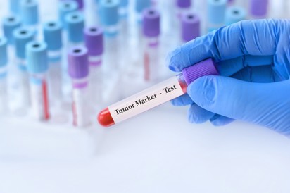 4 jelzés a leleten, mely nőgyógyászati rákra utalhat