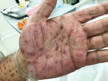 A szifilisz gyógyítható, de ha már kialakulnak szövődmények, azok már nem fognak eltűnni a penicillin kezelés után. A gyógyulás nem akkor áll be, amikor már nincs tünete a betegnek, hanem akkor, ha a vértesztek eredménye alapján az orvos azt mondja.