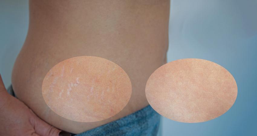 Csíkok a bőrön: striának tűnhetnek, de hormonbetegség is okozhatja őket |  EgészségKalauz