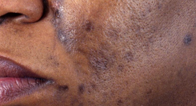 Hyperpigmentation and acne ruins the skin [afpg]