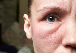 Angioedem se najčešće javlja na licu, ali može i u bilo kom delu tela 