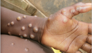 Monkey pox is a rare disease caused by monkeypox virus [WHO]