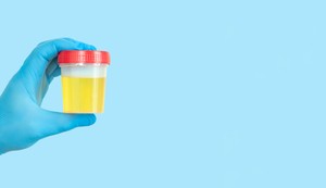 Test proteina u urinu