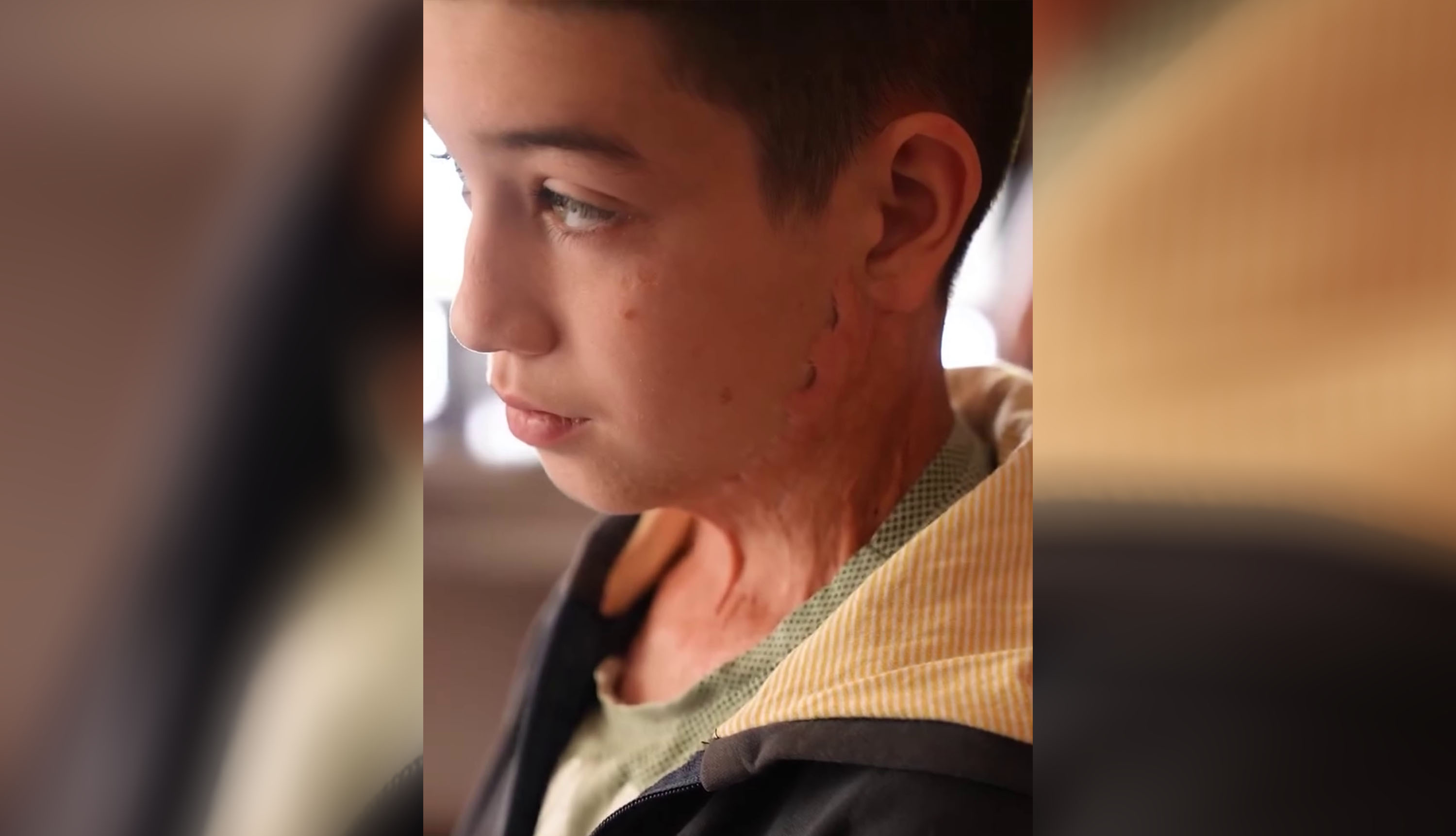 (VIDEO) NIKOLU MAJKA POLILA KISELINOM, PA SKOČILA SA NJIM SA 3. SPRATA Jeziva sudbina dečaka potresla Srbiju: Čudom preživeo, a sada mu je HITNO POTREBNA NAŠA POMOĆ