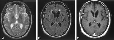 MR Imaging of human African trypanosomiasis