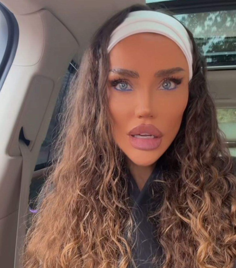 Bianca Drăgușanu și-a topit acidul hialuronic din buze din nou: „Acum sunt aproape de forma care îmi place”. La operațiile estetice nu renunță