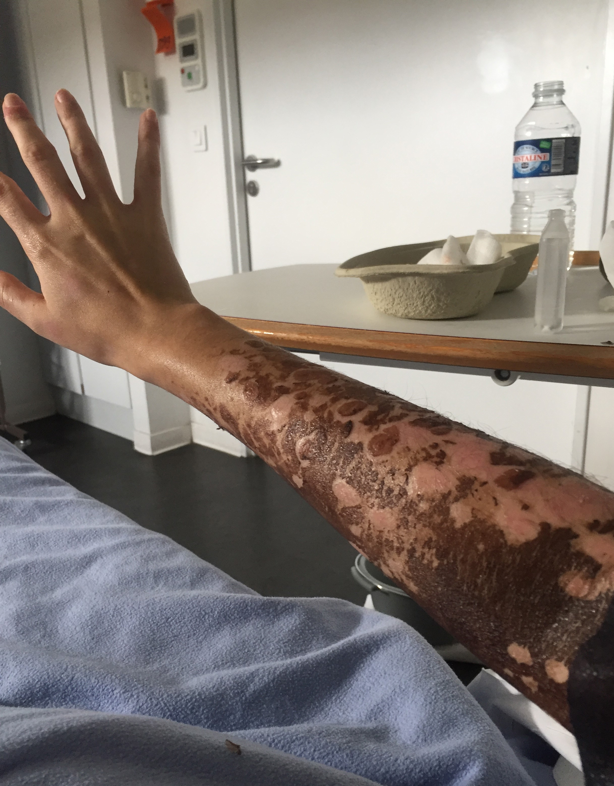 Fotografii cu puternic impact emoțional! Un medicament banal pentru amigdalită a desfigurat-o și i-a provocat arsuri groaznice pe 90 la sută din piele! Mărturiile cutremurătoare ale victimei