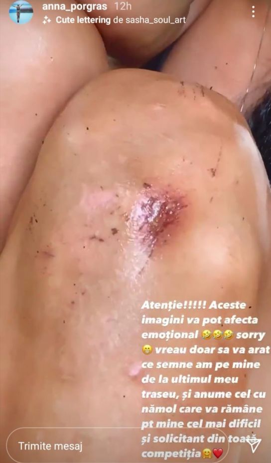 Ana Porgras, grav accidentată după ultimul joc de la „Survivor România”. Și-a arătat rănile