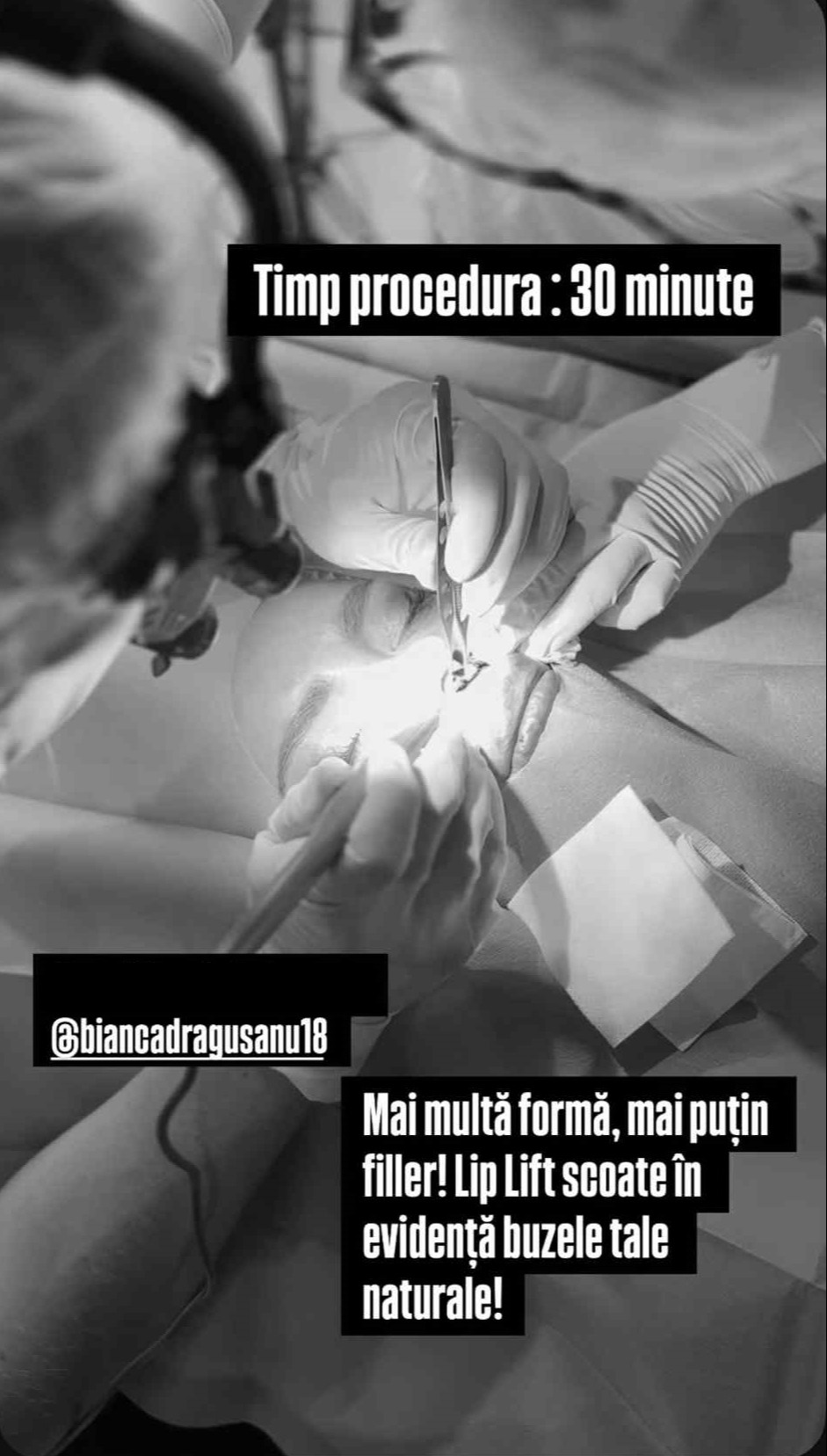 Bianca Drăgușanu și-a făcut o nouă operație estetică la față. Cât costă procedura chirurgicală care e gata în 30 de minute: „Va fi wow”