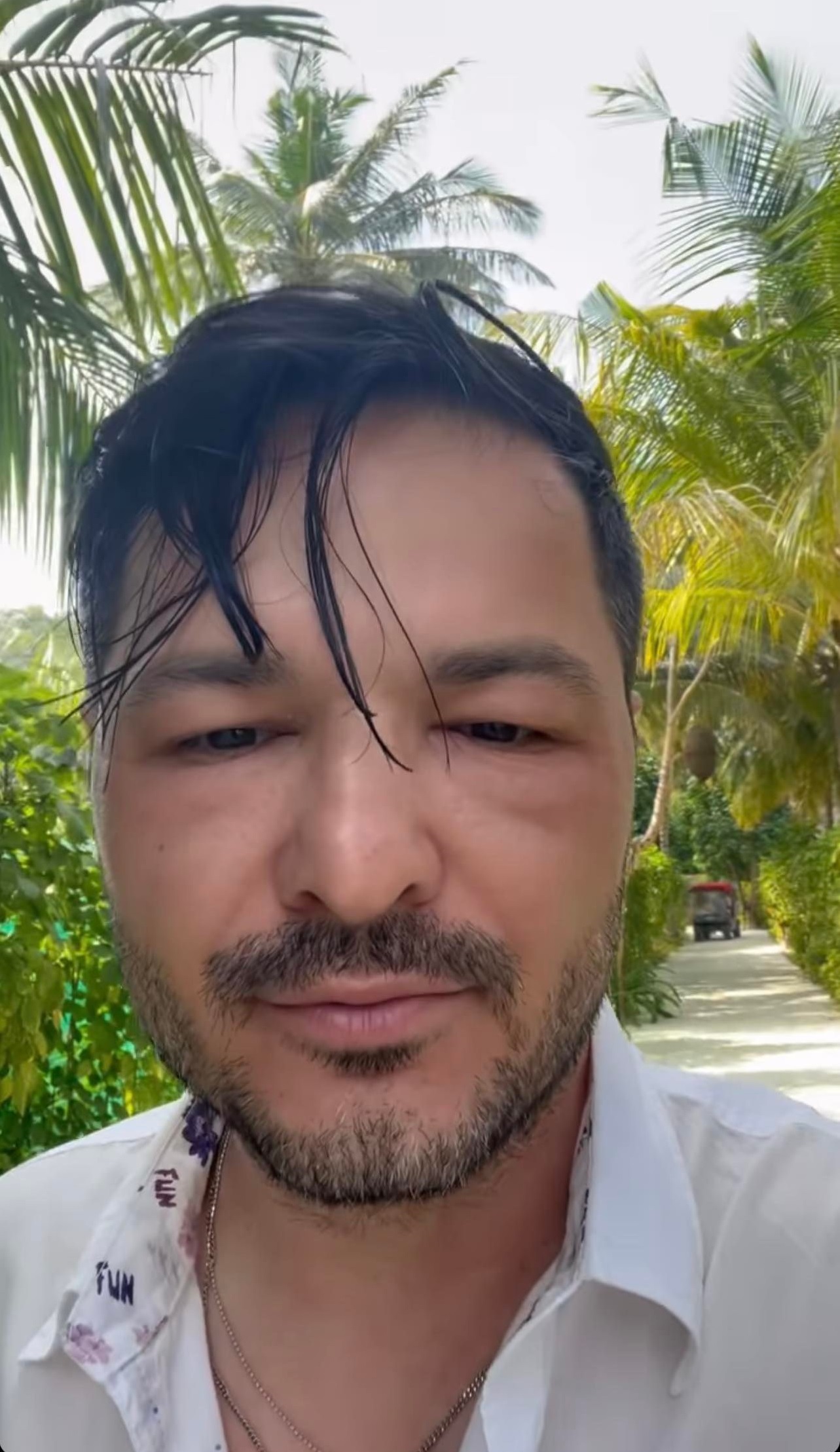 Liviu Vârciu, cu fața umflată în vacanță. Ce a pățit prezentatorul de la Antena 1