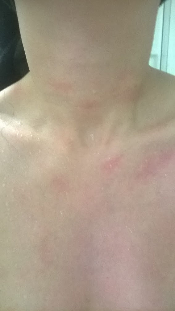 FOTO | O tânără suferă de alergie la frig. Cum poate ieși din casă pe timpul iernii