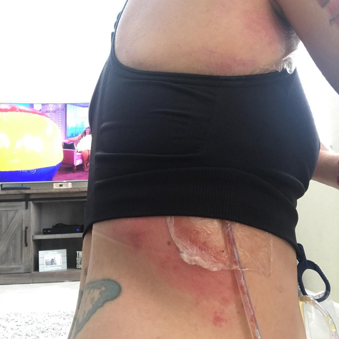 O mamă s-a ales cu o boală nouă după ce a făcut o operație "la modă" printre femei: "Dacă știam că poate provoca atâta durere, n-o mai făceam niciodată"