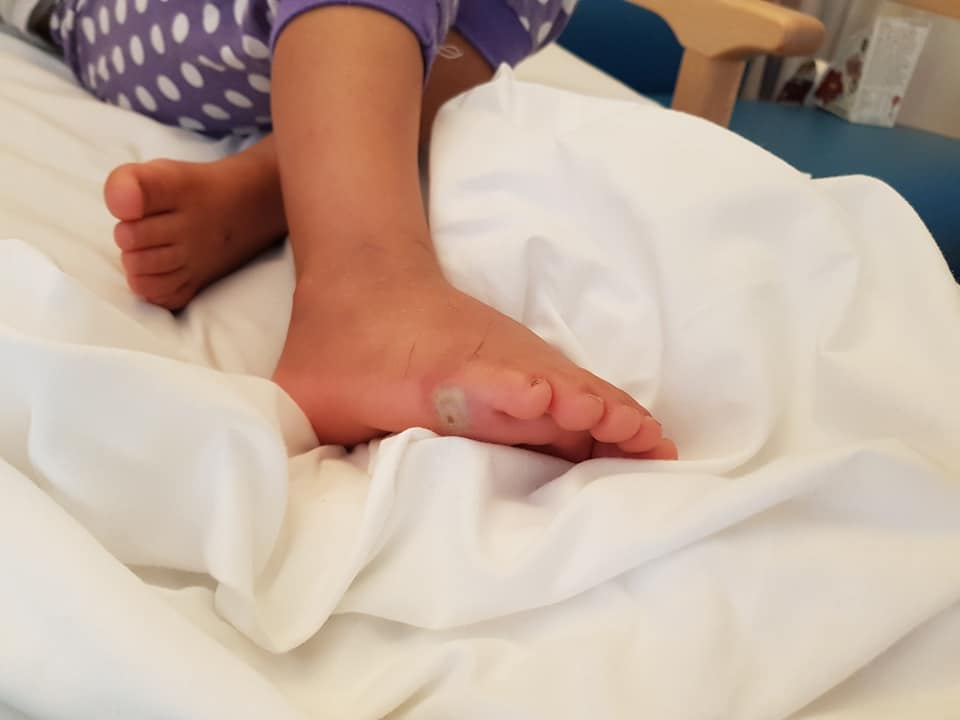 FOTO | O fetiță a făcut septicemie de la o bacterie pe care a luat-o probând o pereche de pantofi