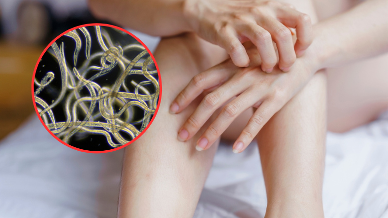 Objawy, że zalęgły się pasożyty. Zauważysz na skórze, zwłaszcza nocą