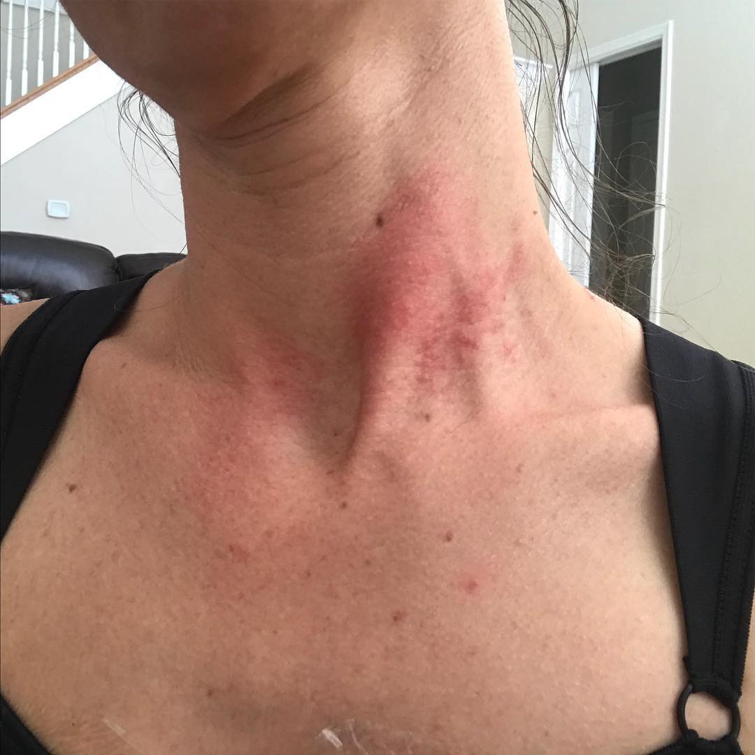O mamă s-a ales cu o boală nouă după ce a făcut o operație "la modă" printre femei: "Dacă știam că poate provoca atâta durere, n-o mai făceam niciodată"